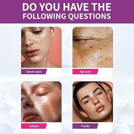 Spot Fading Urea Cream – Dark Spot Removal, Whitening & Freckle Reduction Cream